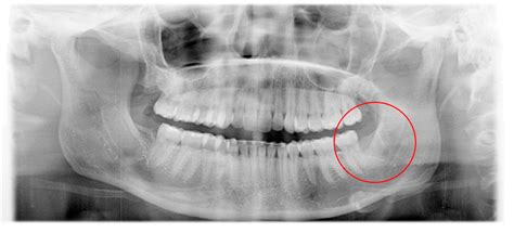 Osteomyelitis After Wisdom Tooth Extraction