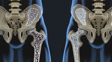 home.furnitureanddecorny.com:osteoporosis hip injury