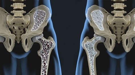 osteoporosis hip injury