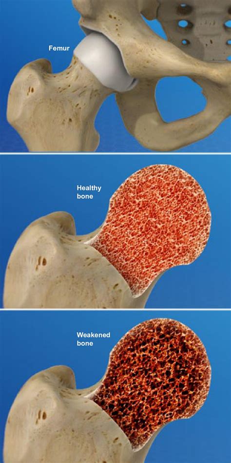 osteoporosis hip injury