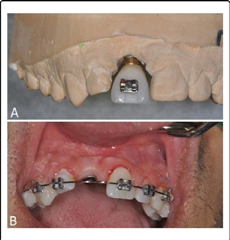 Osteotomy Dental Code