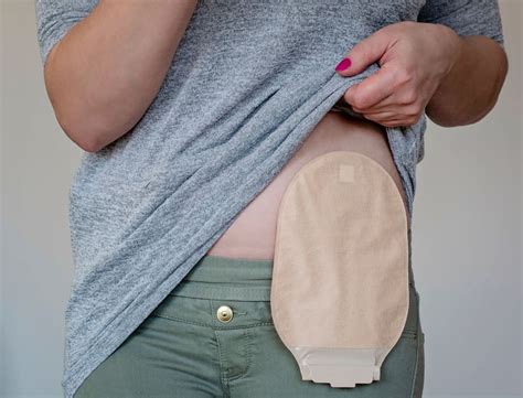 Ostomy Bag Cpt Code