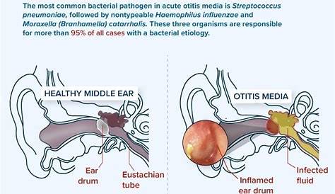 Otitis Externa Causes Tinnitus Effective Treatment For Acute