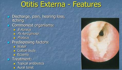 Otitis Externa Causes Eye Diseases Media And Ppt Video Online