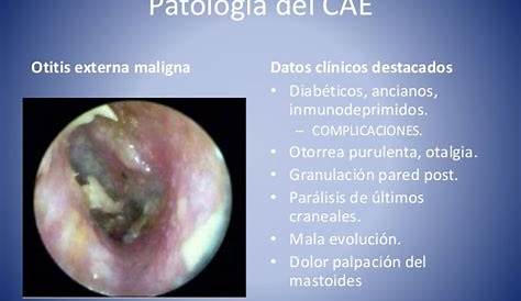 Involvement Of Outer Ear Skin In Otitis Externa A B With