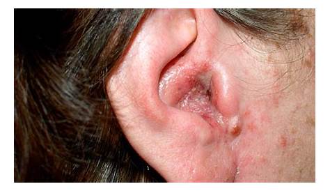 Otitis Externa Maligna