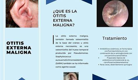 Otitis Externa Maligna Tratamiento Dr Rafael Gutierrez Garcia Ppt Video Online Descargar