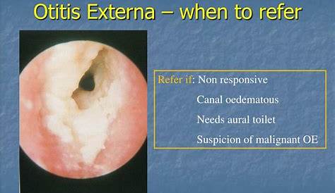 Acute Otitis Externa An Update American Family Physician
