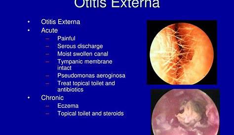 Otoscopic Signs Of Acute Otitis Media Youtube