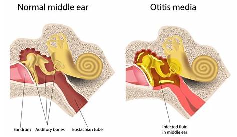 Otitis Media Causes Bacteria Upper Respiratory Tract Infections Ppt Video Online Download