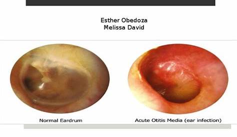 Otitis Media Images To Treat To Refer To Do Nothing A Review For The