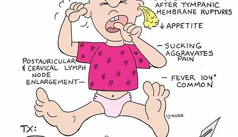 Otitis Media Symptoms Baby Acute