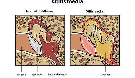 Otitis Media With Effusion Images 2 Otoscopic Aspect Of Download