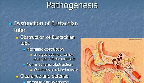 Otitis Media With Effusion