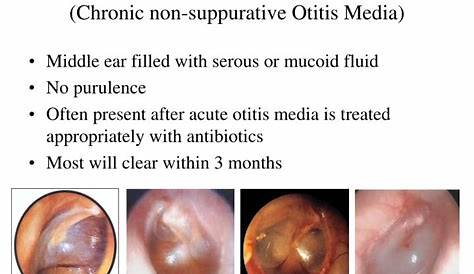 Otitis Media With Effusion Treatment Uptodate Acute Externa An Update American Family Physician