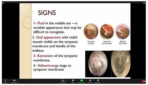 Ear Fluid Vs Ear Infection Otitis Media With Effusion Ome Ear