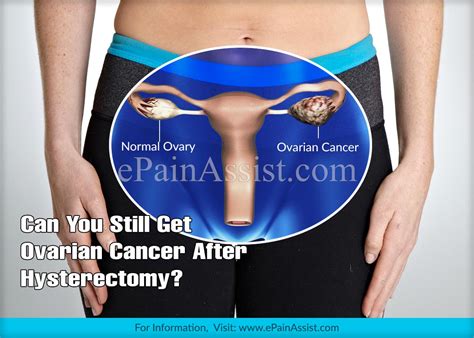 Ovarian Cancer After Hysterectomy Is It Possible?