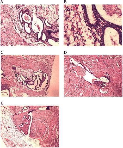 ovarian endometrioma icd 10