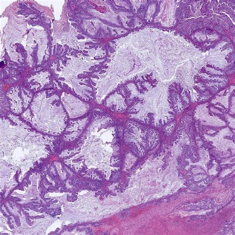 ovary mucinous borderline tumor histology