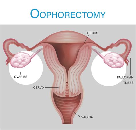 Understanding Ovary Removal Surgery: Risks, Benefits, and Recovery