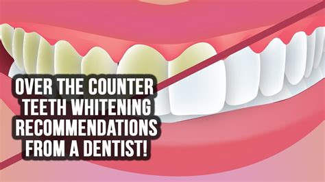 Pin on Cosmetic Dentistry