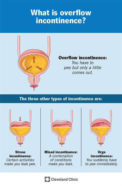 Overflow Incontinence Female