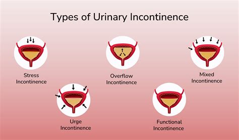 Overflow Incontinence Of Urine Icd 10