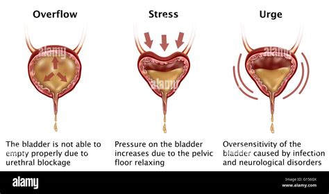 Overflow Incontinence Pathophysiology