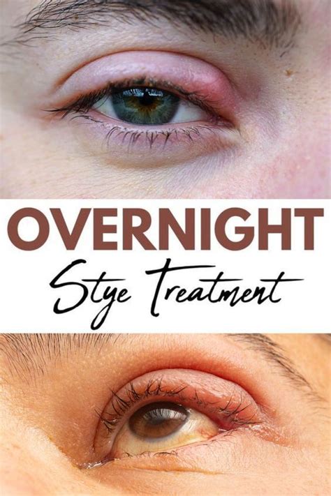 overnight stye treatment over the counter