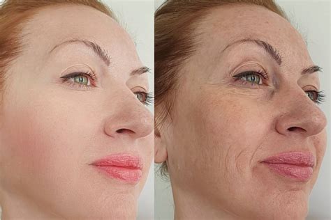 ozempic face examples before and after