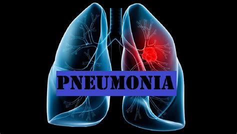 p medical term meaning pneumonia