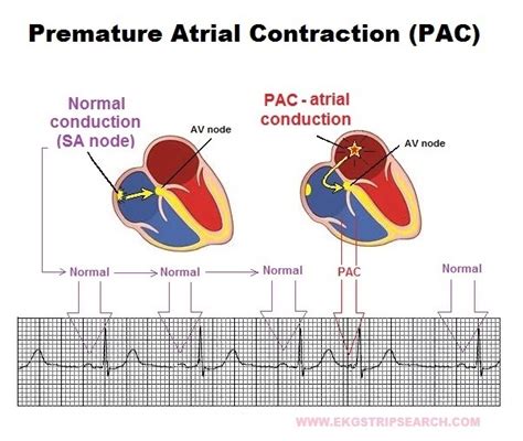 Understanding PAC Heart Arrhythmia: Causes and Effective Treatments