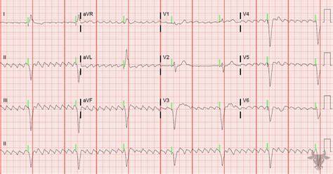 Telemetry Technician Course Atrial Rhythm Quiz