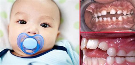 Pacifier Bite Problems