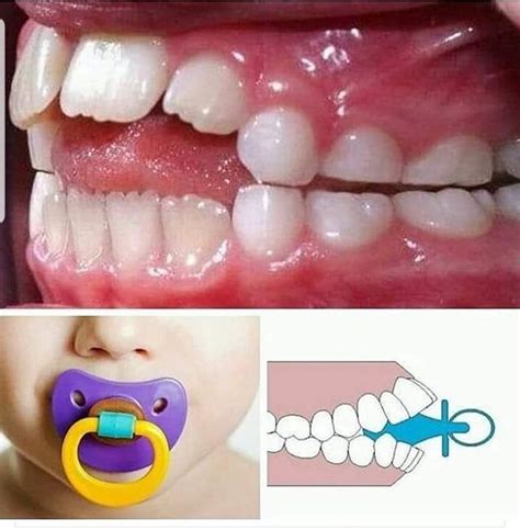 Pacifier Teeth Medical Term
