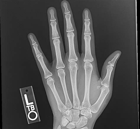 Paediatric Thumb Xray