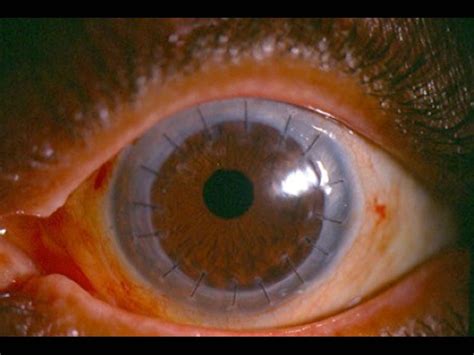 pain after corneal transplant