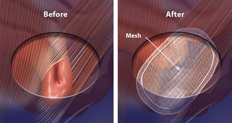 pain after inguinal hernia repair