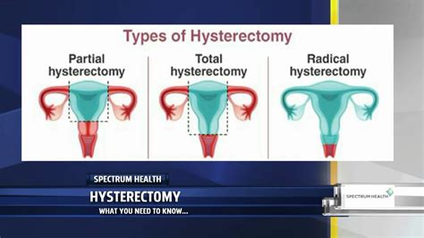 pain after partial hysterectomy