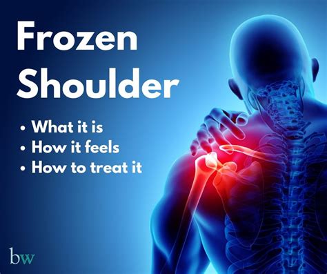 pain relief for frozen shoulder