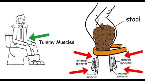 Relieving Painful Anus When Passing Stools: Causes and Solutions