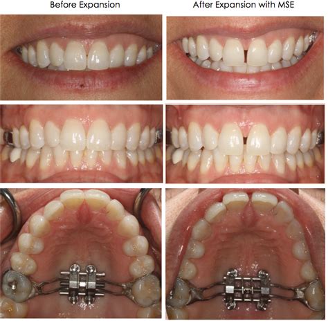 Palate Expander Before And After Gap Review