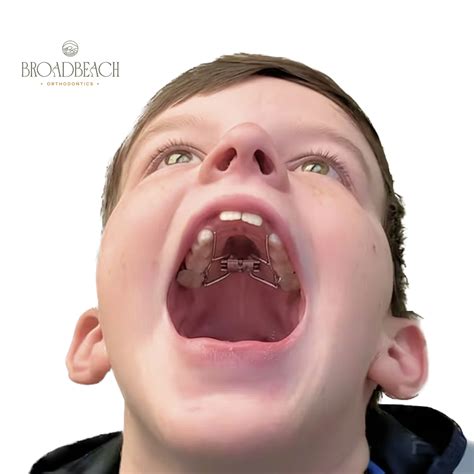 Palate Expander 5 Year Old