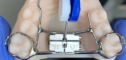 palate expander with key