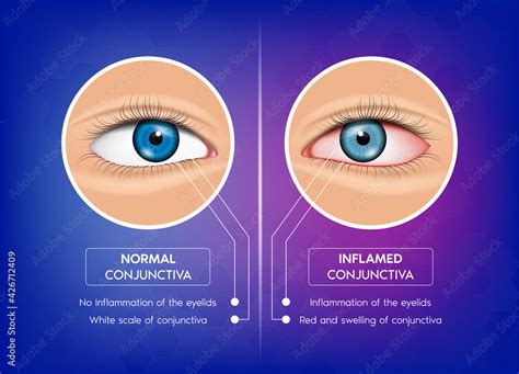 pale conjunctiva vs normal