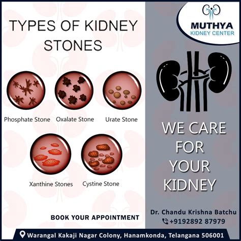Pale Stools Kidney Infection
