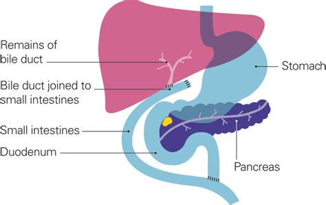 pancreatic cancer and bile duct blockage
