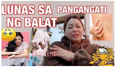 Bungang Araw: Makating Butlig Sa Katawan - Doc Liza Ramoso-Ong