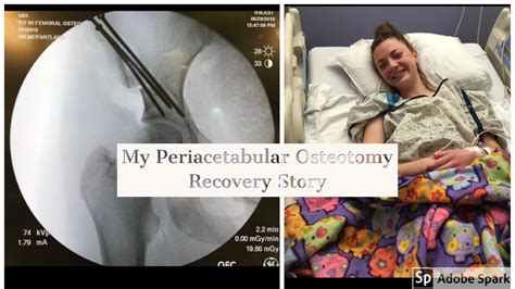 pao surgery recovery reddit