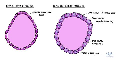 papillary vs follicular thyroid cancer